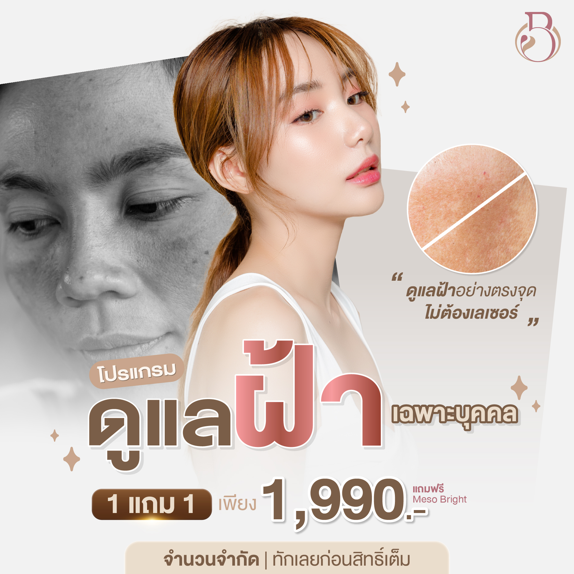 ฝ้า กระ จุดด่างดำ สิว ริ้วรอย รอยดำ